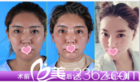 北京圣慈医疗美容医院SC 美翎秘颜悬雕术<span style=
