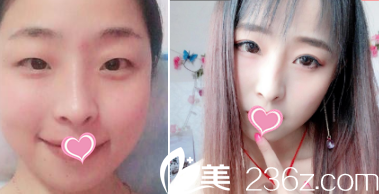 北京圣嘉荣双眼皮案例