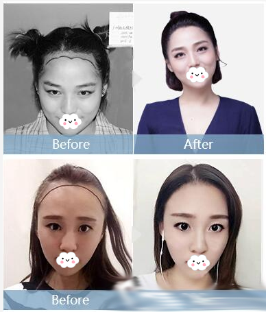 深圳雍禾植发医院女士发际线种植案例 深圳雍禾植发医院女士发际线种植案例