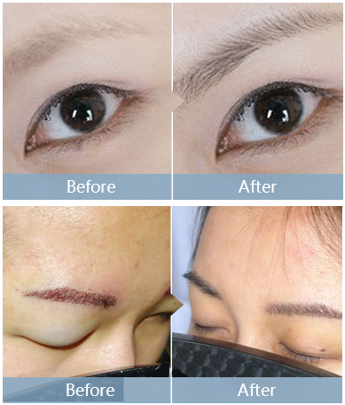 深圳雍禾植发医院眉毛种植案例效果 深圳雍禾植发医院眉毛种植案例效果