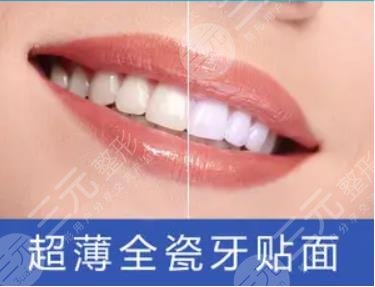 牙齿美白