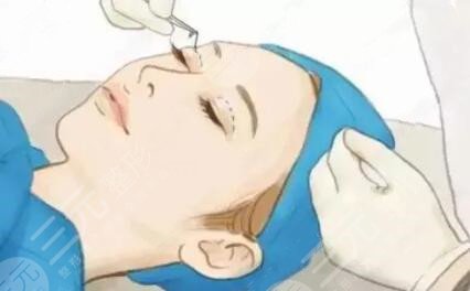 上海九院双眼皮整形案例