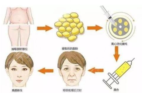 上海脂肪填充面部多少钱？价格是多少？附脂肪填充过程体验+价目表