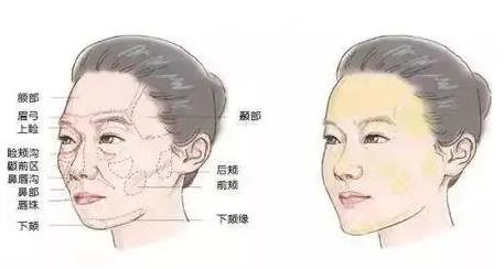 上海面部脂肪填充项目案例体验反馈