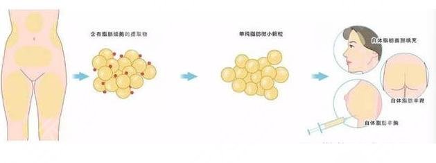脂肪填充面部注意事项