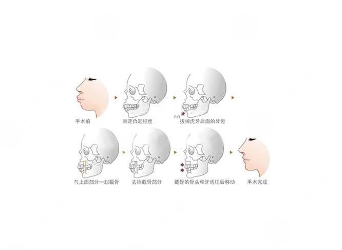 中山一院牙科成功牙齿矫正案例：术前