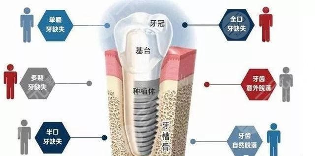 种植牙科普、牙齿种植不适合什么样的人群?