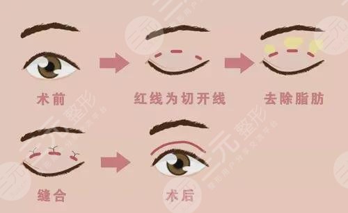成都市第二人民医院双眼皮案例：网友恢复过程日记：术后