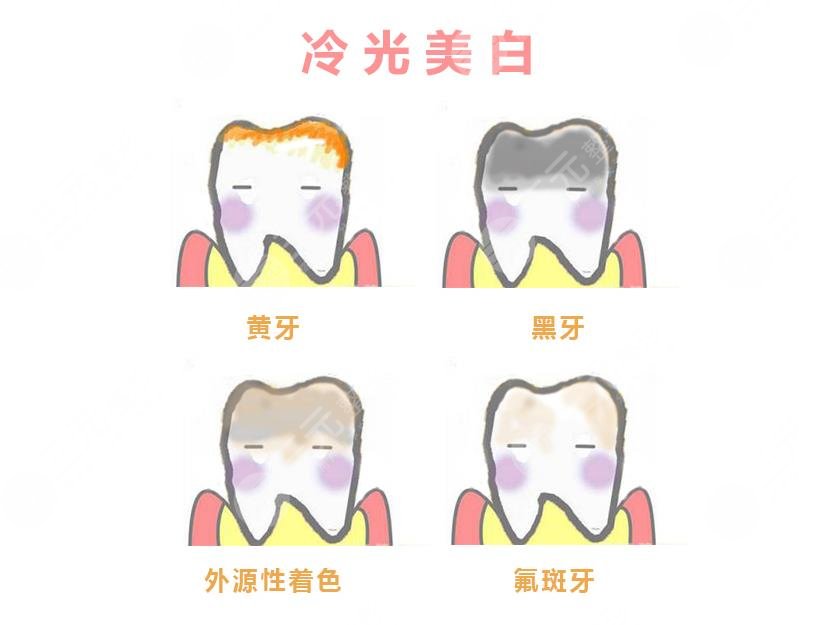 南方医院牙齿美白多少钱?