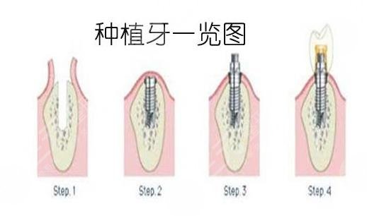 种植牙手术