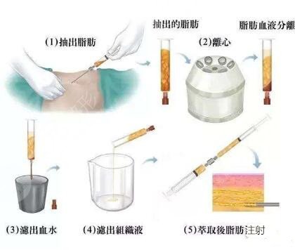 上海九院面部填充案例
