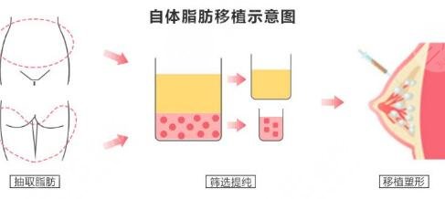 自体脂肪隆胸的果怎么样?