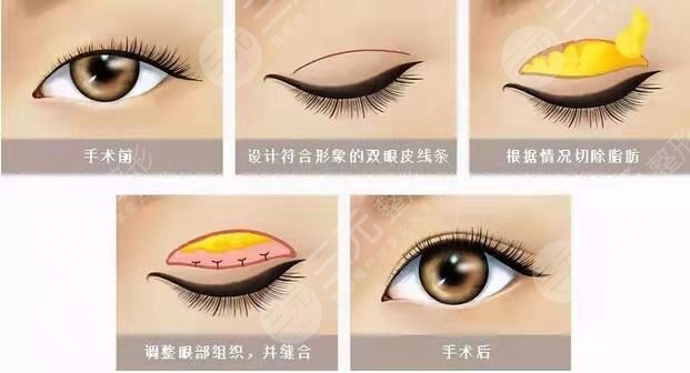 北京八大处双眼皮手术后3天