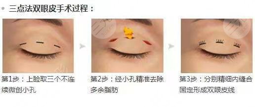 北京八大处双眼皮手术后3个月