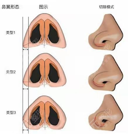 北京协和医院整形科协和王阳隆鼻后恢复