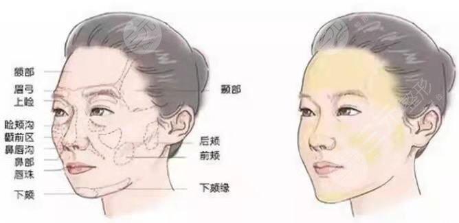 北京东方和谐孙泽芳面部填充术前设计