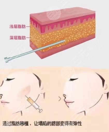北京东方和谐孙泽芳面部填充术后23天