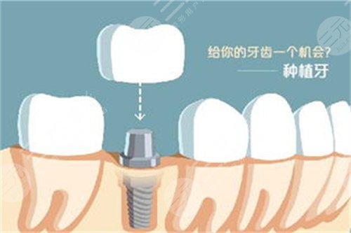 北京维尔口腔医院种植牙怎么样?