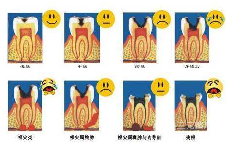 蛀牙补牙费用标准