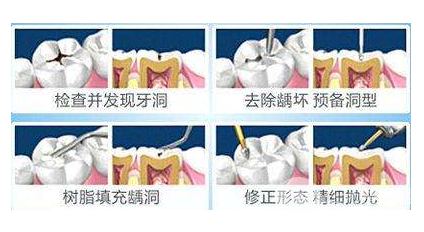 蛀牙补牙费用标准