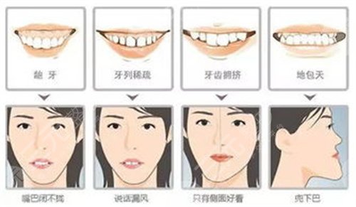长沙美奥口腔医院隐形矫正案例
