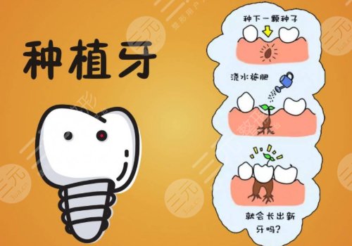单颗牙种植