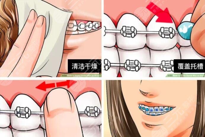 牙齿矫正