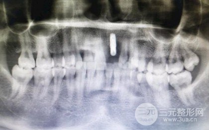 三门峡口腔医院种植牙价格表