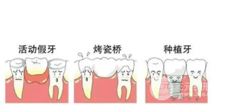 华西口腔医院种植牙价格表
