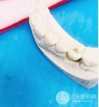 温州附属口腔医院种牙价格表