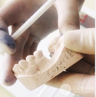 温州附属口腔医院种牙价格表