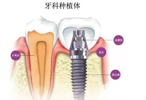 温州附属口腔医院种牙价格表