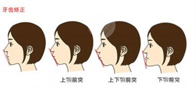 2024江苏省口腔医院种牙|地包天矫正价格表