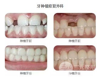 重医口腔种植牙价格表
