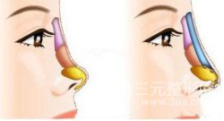 成都隆鼻尖手术多少钱 成都隆鼻尖手术价格表 成都隆鼻尖手术多少钱 成都隆鼻尖手术价格表