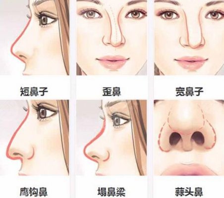 成都歪鼻整形要多少钱 成都歪鼻子整形价格表 成都歪鼻整形要多少钱 成都歪鼻子整形价格表