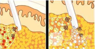 2024成都水动力吸脂去掉双下巴价格表分享 2024成都水动力吸脂去掉双下巴价格表分享