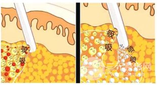 成都水动力吸脂多少钱?附成都水动力吸脂价格表 成都水动力吸脂多少钱?附成都水动力吸脂价格表