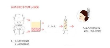 成都自体脂肪丰面颊多少钱?成都自体脂肪丰面颊价格表 成都自体脂肪丰面颊多少钱?成都自体脂肪丰面颊价格表
