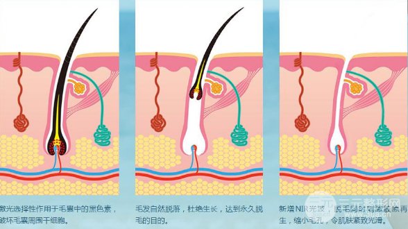 成都激光脱毛大概需要多少钱?成都激光脱毛价格表 成都激光脱毛大概需要多少钱?成都激光脱毛价格表