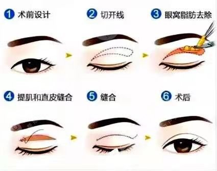 双眼皮术后两个月