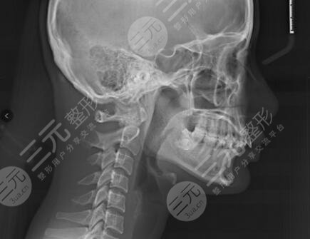 交大口腔医院牙齿矫正前