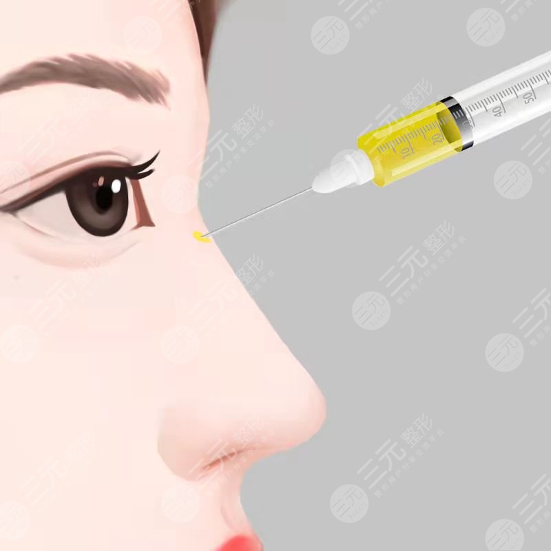 北京诺俪医疗美容自体脂肪隆鼻前