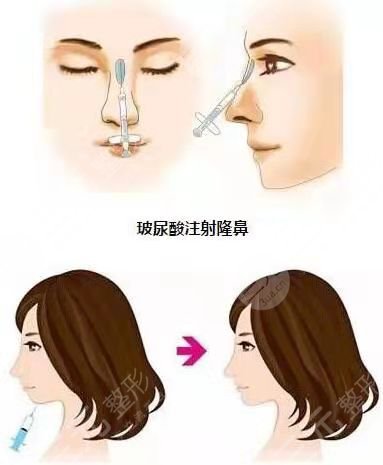 北京诺俪医疗美容自体脂肪隆鼻后63天