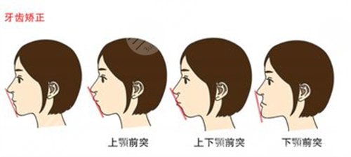 北京大学口腔医院正畸科牙齿矫正过程